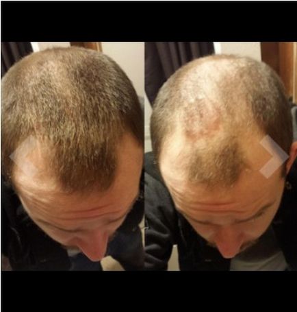 Ideiglenes szőr „permet, amely elfedi a rossz kopasz vagy vágott (spray) Ideiglenes szőr „spray, amely elfedi a kopasz vagy rossz hajvágás