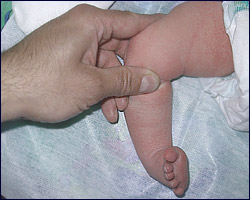 Copilul congenital