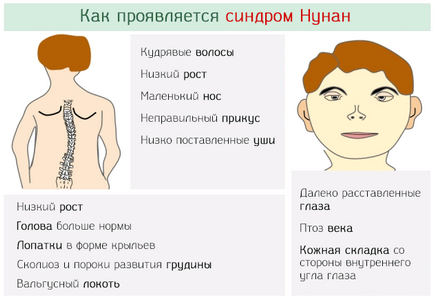 Sindromul nunian congenital la copii - recomandări pentru părinți