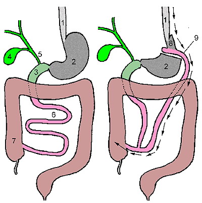 Bypass gastric