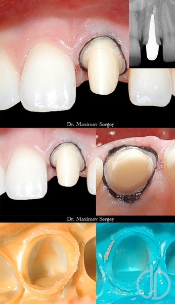 Dibluri dinte - extragerea inserțiilor metalice din dinte