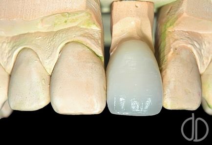 Suporturi dentare - extragerea inserțiilor metalice din dinte