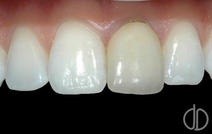Suporturi dentare - extragerea inserțiilor metalice din dinte