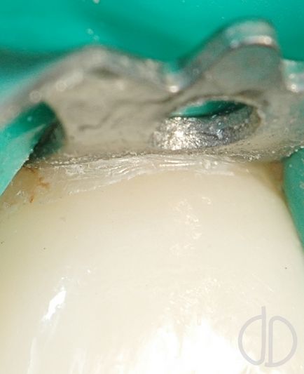 Dibluri dinte - extragerea inserțiilor metalice din dinte