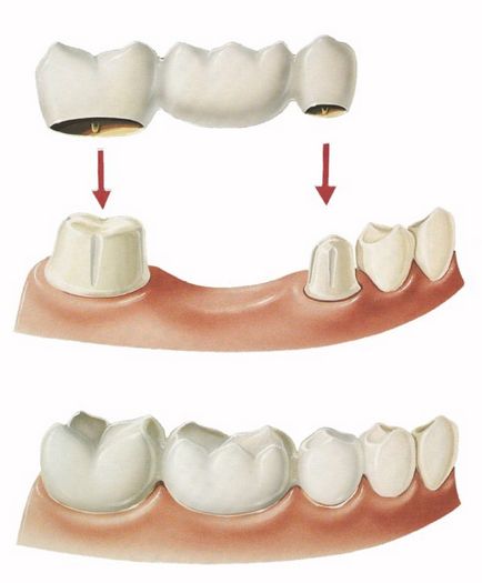 Зубне протезування види, особливості конструкцій і установки