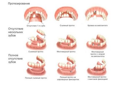 Tipuri protetice dentare, caracteristici ale structurilor și instalării