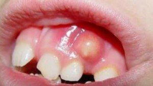 Абсцеси стоматологічні причини, симптоми, лікування, профілактика
