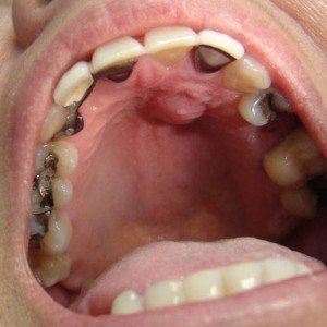 Abcese de cauze dentare, simptome, tratament, prevenire