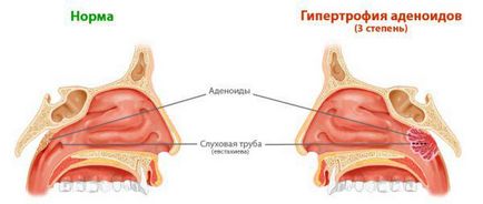 Adenoidele la simptomele adulților și tratamentul fără intervenție chirurgicală, ultrasunete, inflamație, eliminare