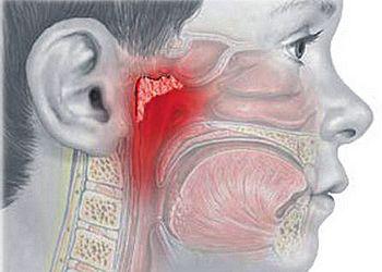 Аденоїди у дорослих симптоми і лікування без операції, ультразвуком, запалення, видалення