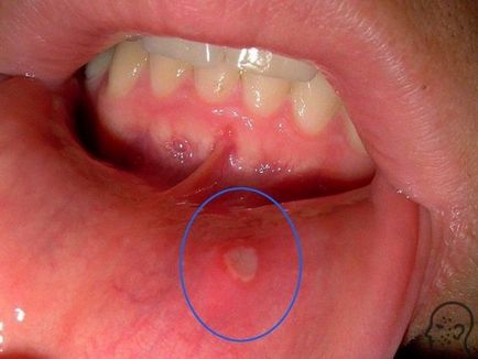 Stomatita aftoasă - cum arată (fotografie), tratamentul și simptomele