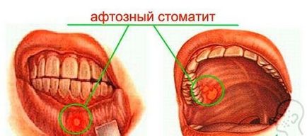 Афтознийстоматит - як виглядає (фото), лікування і симптоми