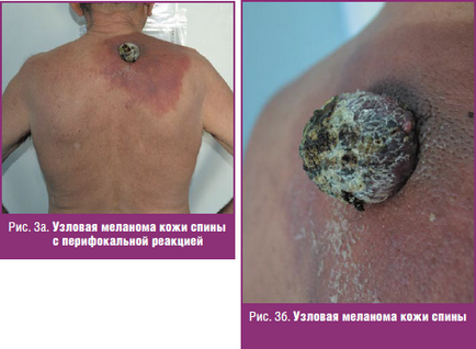 Algoritmi pentru diagnosticarea precoce a melanomului cutanat, # 12