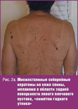 Algoritmi pentru diagnosticarea precoce a melanomului cutanat, # 12