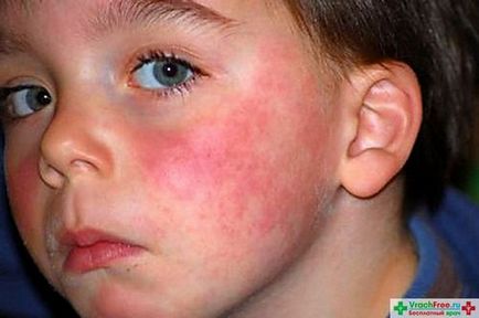 Алергія на сонце у дитини, алергія у дітей