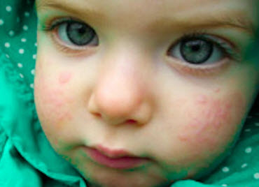 Alergia la soare la un copil, o alergie la copii