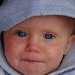 Alergii, erupții cutanate, transpirații, acnee și erupții cutanate la nou-născut pe față, care sunt cauzele lor și eficiente
