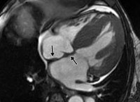 Amiloidoza inimii - cauze, simptome, diagnostic și tratament