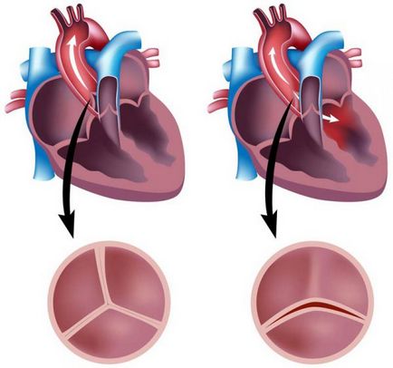 Stenoza aortică cauzează, simptome, diagnostic și tratament
