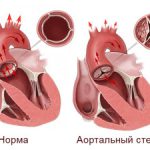 Stenoza aortică cauzează, simptome, diagnostic și tratament