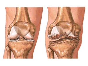 Osteoartrita articulației genunchiului, tratamentul gonartrozei articulației genunchiului, gradul de artroză a articulației genunchiului,