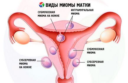 Durere în miomul uterin