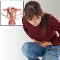 Fájdalom a méhben myoma (fibroidok) Fájdalom a méh myoma