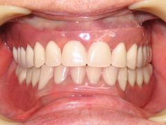 Чим чистити зубні протези огляд засобів