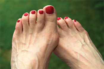 Ce este halus valgus (hallux valgus)