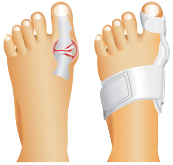 Ce este halus valgus (hallux valgus)