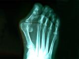 Mi halyus valgus (deformitás) (hátsó felületén sarok) Mi halyus valgus (deformitás)