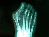 Що таке халюс вальгус (hallux valgus)