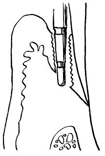 Instrumente dentare de diagnosticare - stomatologie, instrumente dentare -