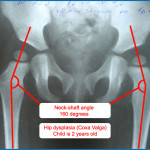 Displazia articulațiilor șoldului la copii, tratament