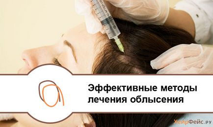 Ефективні методи лікування облисіння у чоловіків і жінок