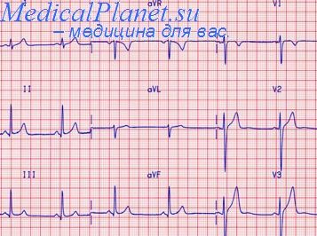 Ekg în timpul unui atac de ibs