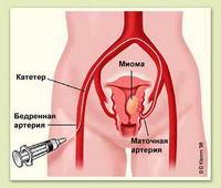 Емболізація маткових артерій (ЕМА)
