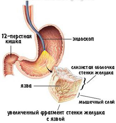 Ендоскопія шлунка показання, проведення та ускладнення