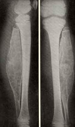 Fibromul osului - formațiuni noi de origine osteogenă - boli ale oaselor la copii - sănătate