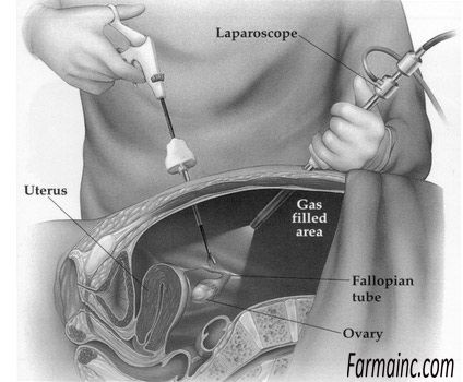 Chistul folicular