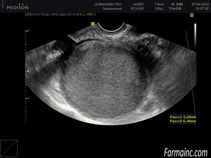 Chistul folicular