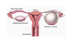 Simptome și terapii chist ovariene foliculare