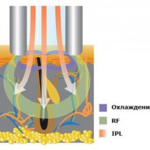 Фотоепіляція e-light, кабінет епіляції de-light