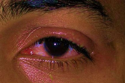 Herpesul pe ochi sunt două cauze ale unei probleme