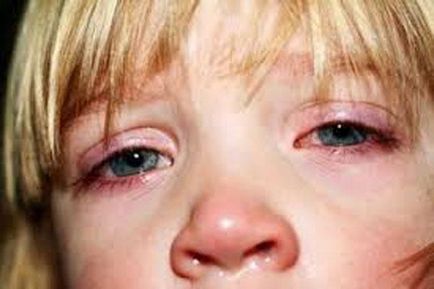 Herpesul pe ochi sunt două cauze ale unei probleme