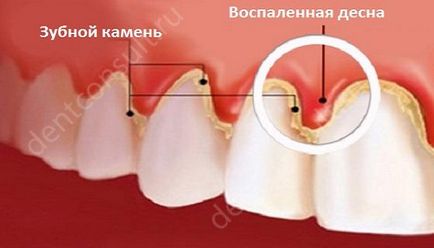 Гінгівіт у дорослих симптоми і лікування фото приклади