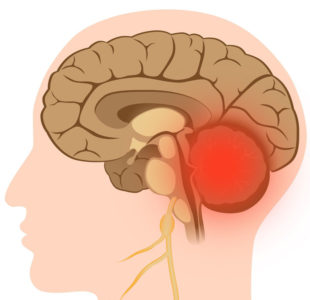 Hypercorticismul (sindromul iscenko-cushing), ceea ce este, simptomele