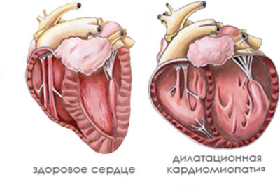 Hypercorticismul (sindromul iscenko-cushing), ceea ce este, simptomele