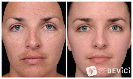 Glicolic peeling recenzii reale, fotografii și contraindicații