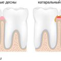 гнійний гінгівіт